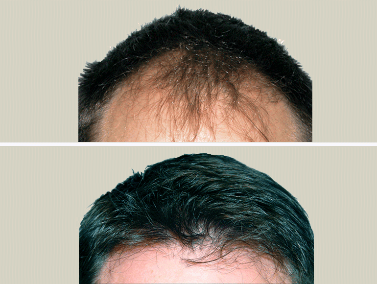 Un homme avant et après avoir eu une greffe de cheveux