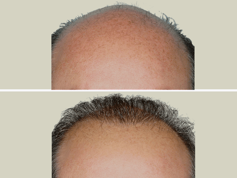 Résultat avant-après d'une greffe de cheveux chez un homme