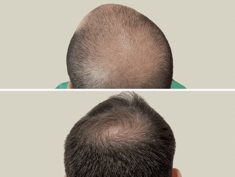 Un homme avant et après une greffe de cheveux