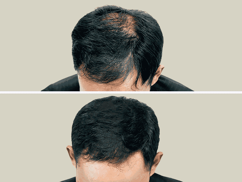 Les cheveux avant et après une greffe capillaire