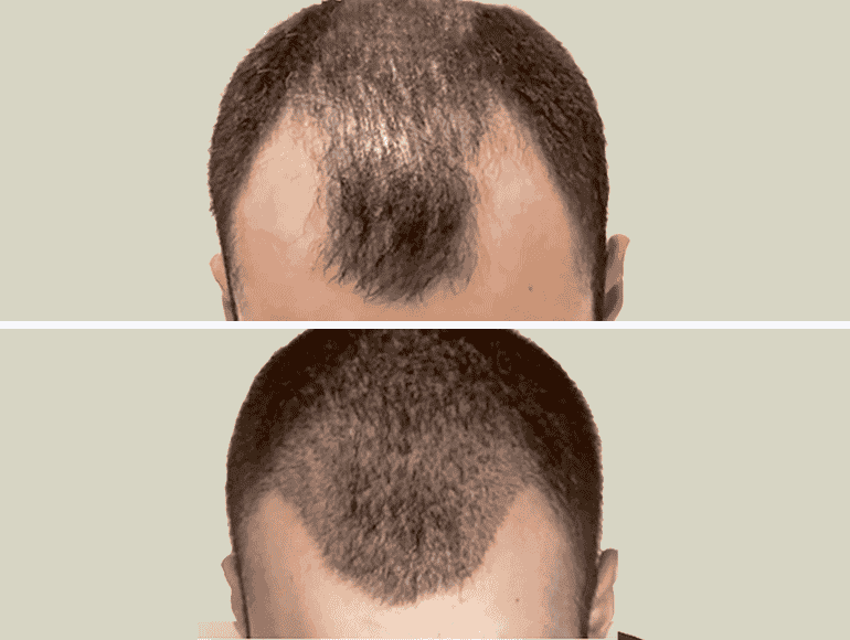 Un homme avant la greffe de cheveux VS après la greffe