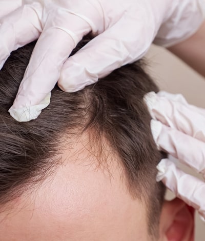 Perte de cheveux chez l'homme