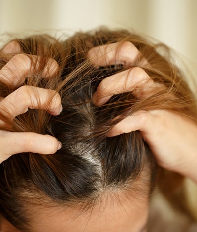 Psoriasis cuir chevelu