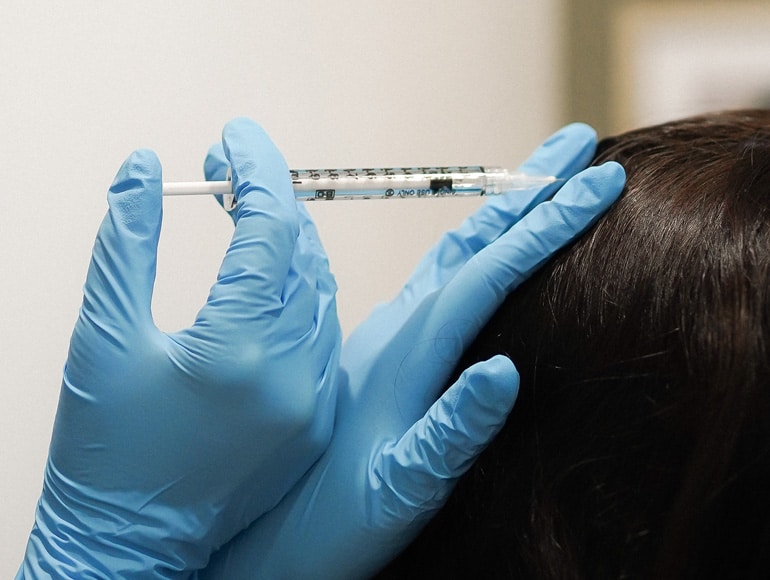 Traitement de PRP cheveux pour stimuler la repousse capillaire