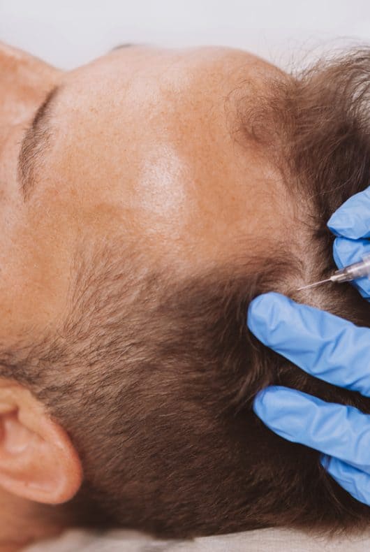Homme recevant une injection de plasma riche en plaquettes pour les cheveux